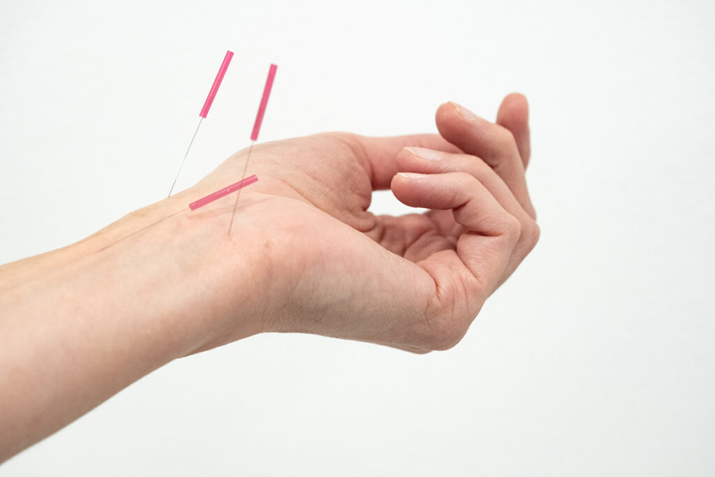 acupuncture london traditional chinese medicine