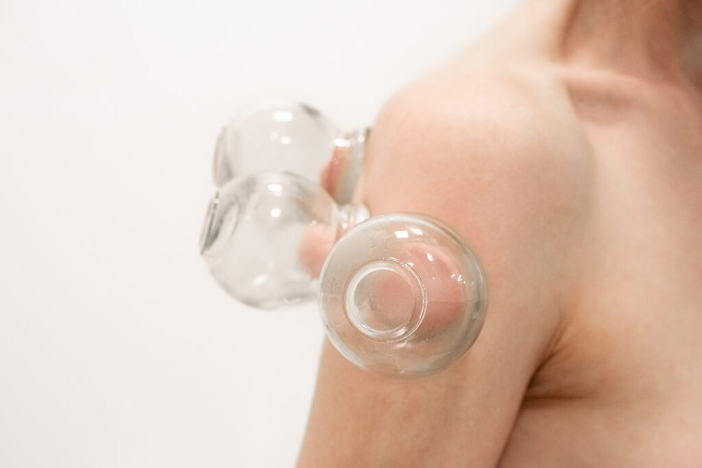 acupuncture london traditional chinese medicine